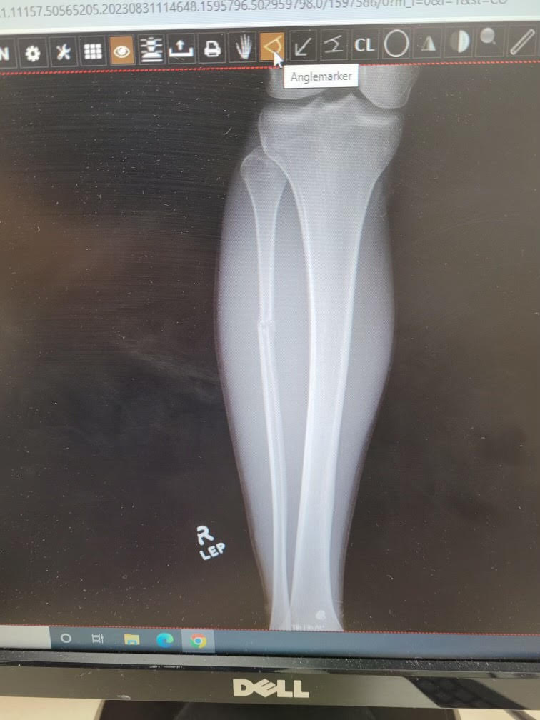  Picture of the ex-ray of Nathan’s leg when he went to the doctor following his injury. He was diagnosed with a fractured fibula and was told he would be out for the season. (Photo provided by Wayne Parnell)